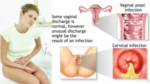 vaginal discharge-5-601