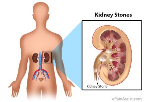 kidney-stone-final-300x206