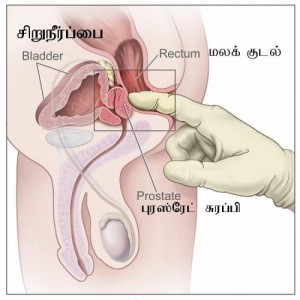 prostate-cancer-symptoms