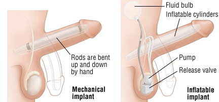 Problems with taking testosterone