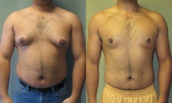 GynecomastiaFrontalAsymSevere