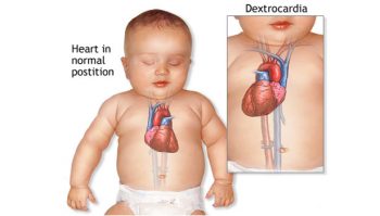 201609130845190939_heart-defects-in-children_secvpf