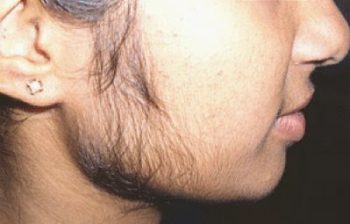 hirsutism1