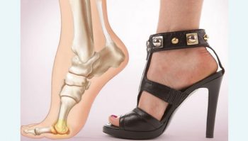spinal-cord-caused-by-the-use-of-high-heels-for-women