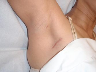 pain-under-right-armpit